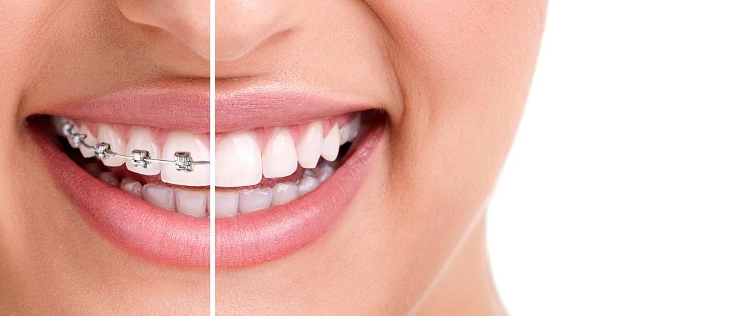 Impact Orthodontics: Setting the Standard for Excellence in Calgary Orthodontic Care
